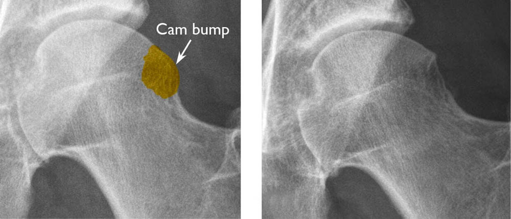Radiographs before and after arthroscopic femoral osteochondroplasty, showing the cam bump resected